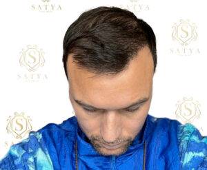 hair transplant results