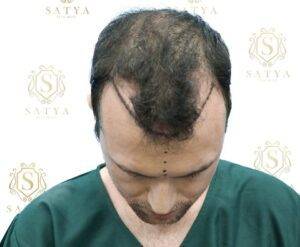 before hair transplant image