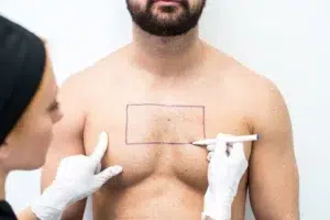 Body Hair Transplant