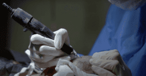 hair transplant - Satya hair Solutions
