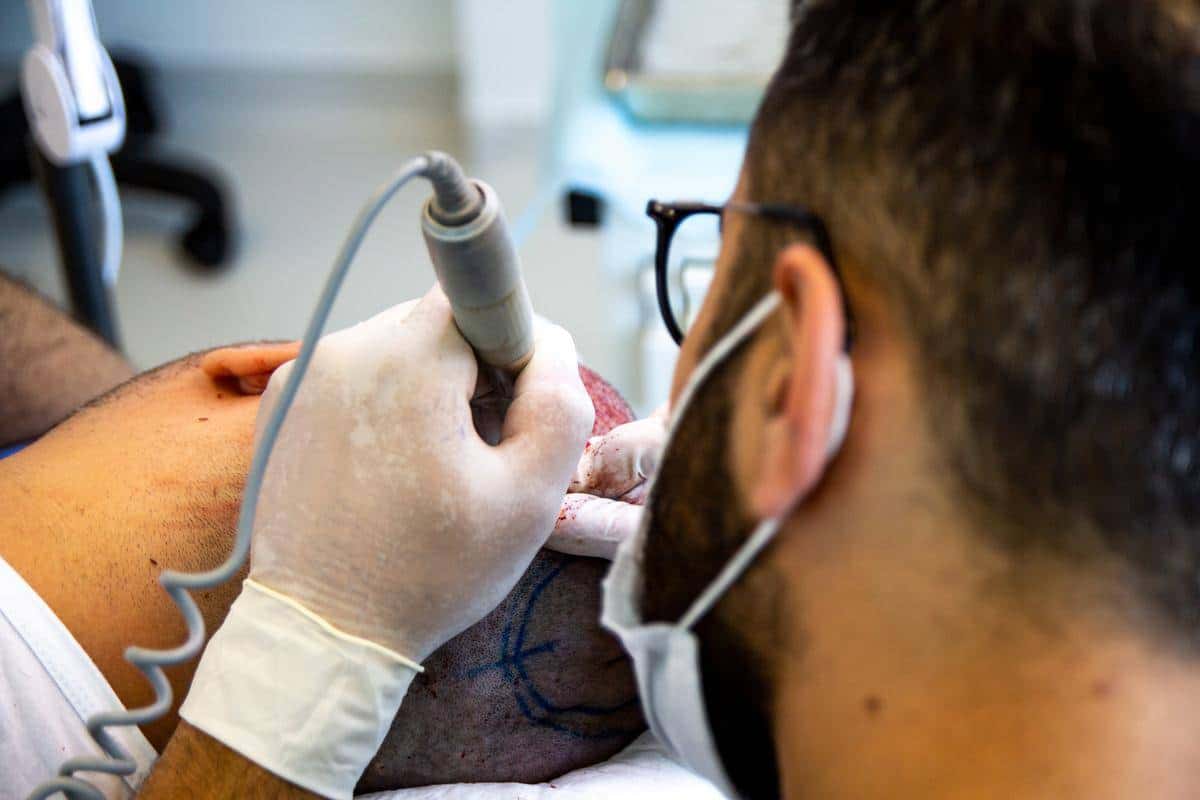 FUE Hair transplant