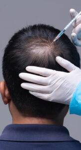 prp hair treatment
