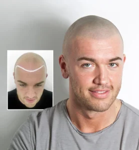 Scalp Micropigmentation