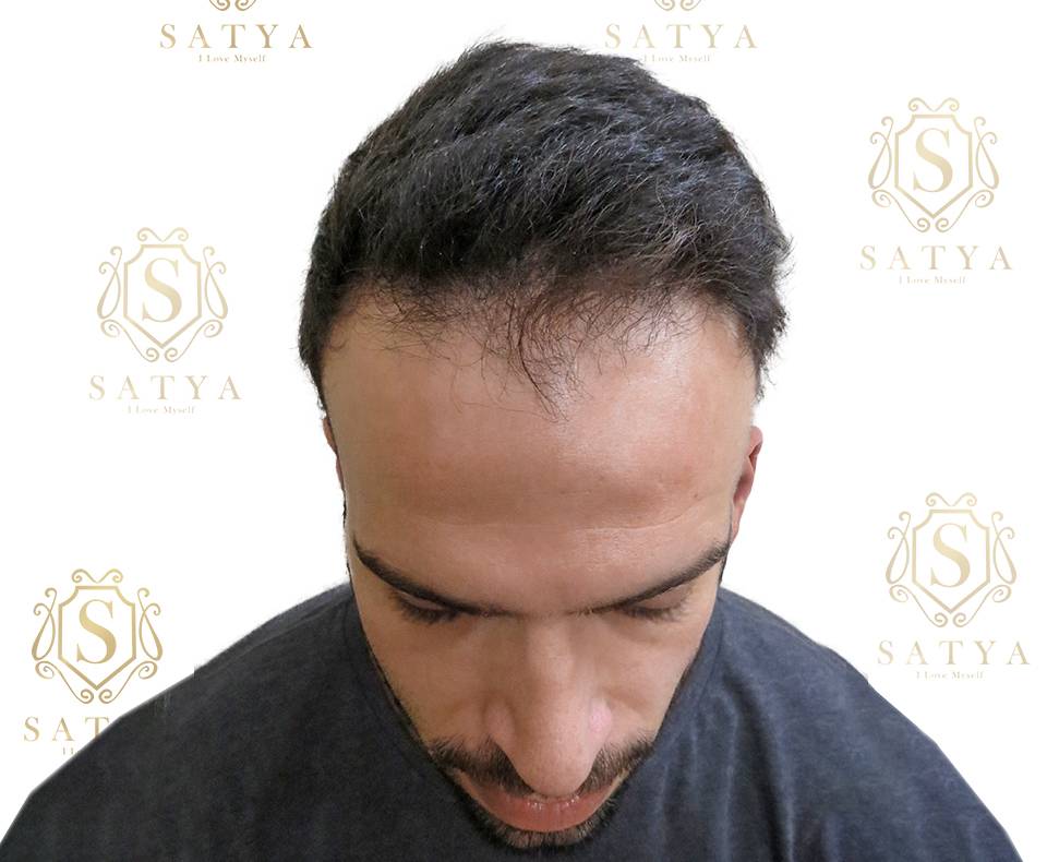 before image of hair transplant