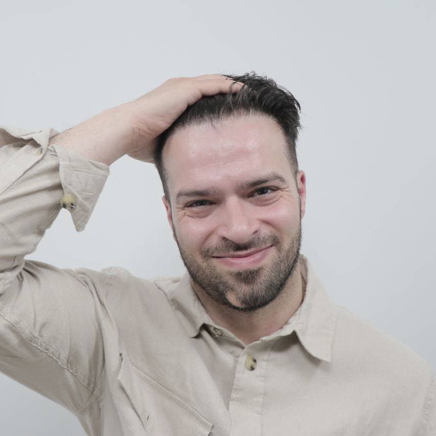 successful hair transplant results