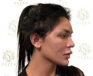 transgender hair transplant