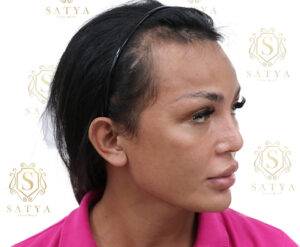 transgender hair transplant