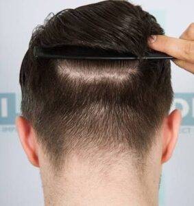 hair transplant results