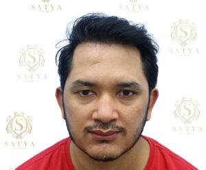 after hair transplant