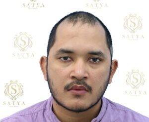 before hair transplant