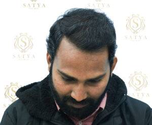 After hair transplant