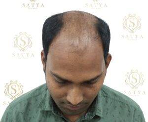 before hair transplant