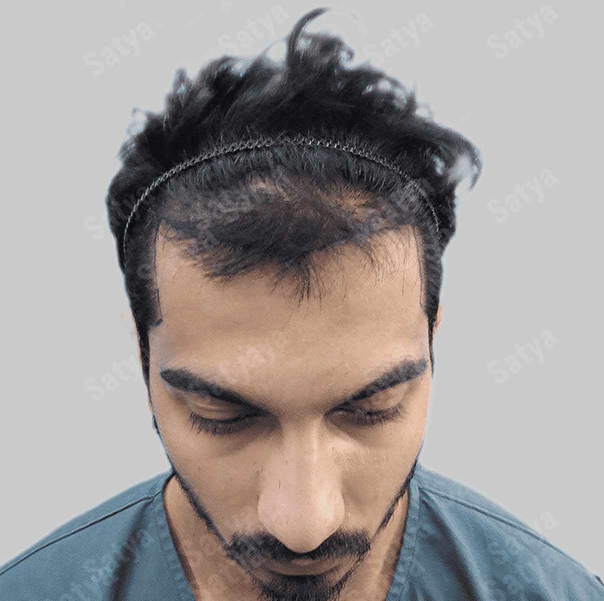hair transplant before image