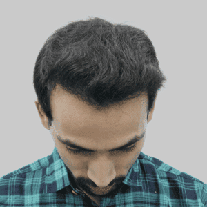 hair transplant After image