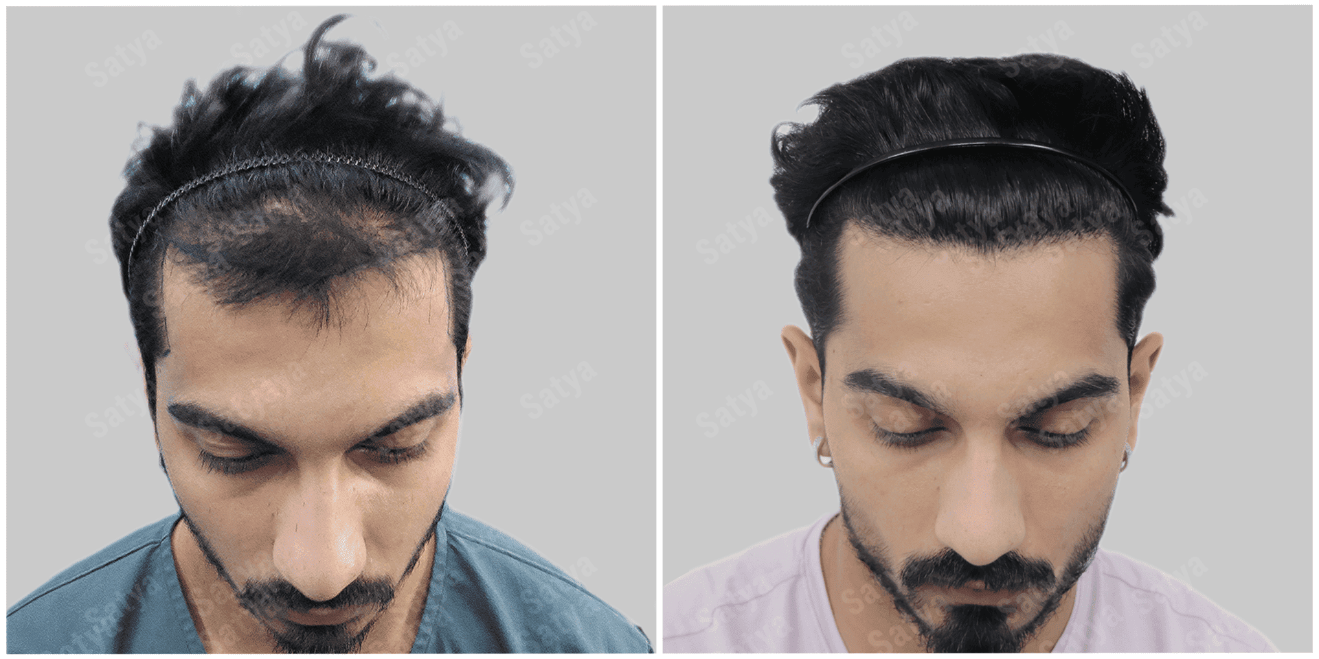 best results of hair transplant at Satya hair solutions