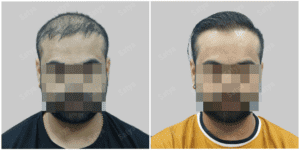 hair transplant in australia