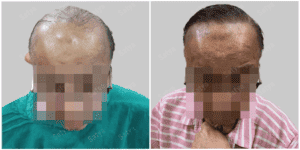 hair transplant results before and after