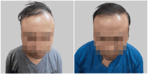 hair transplant results before and after