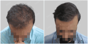 hair transplant results before and after