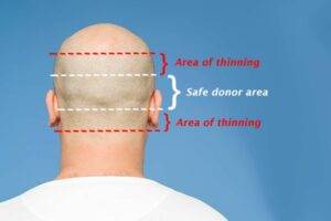donor area