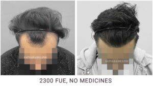 fue hair transplant