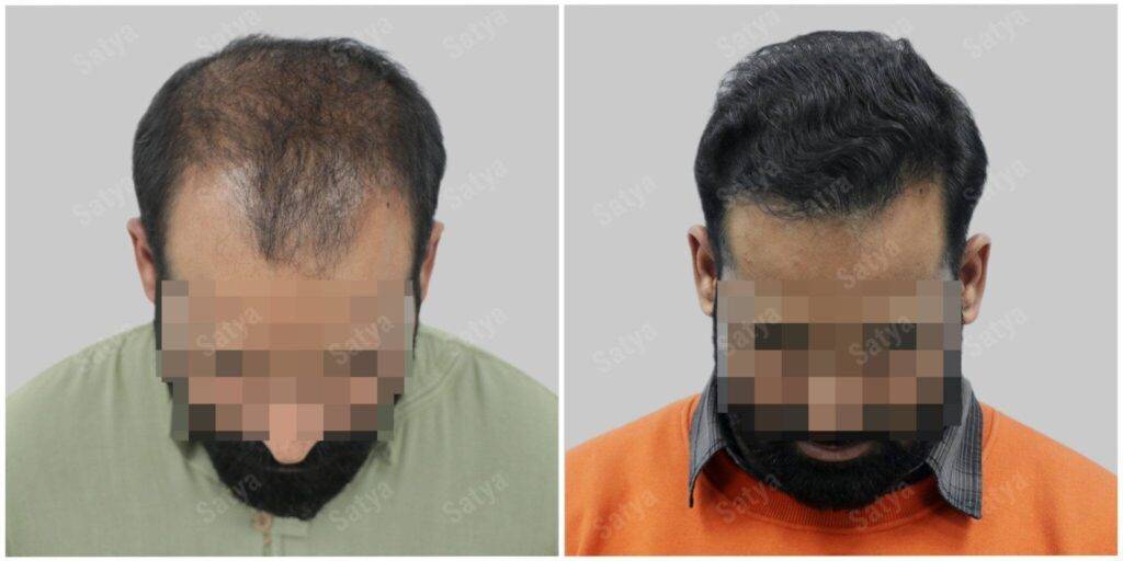 hair transplant - Satya hair solutions