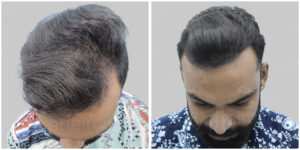 fue hair transplant