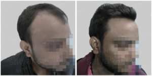 fue hair transplant