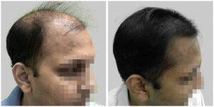 fue hair transplant