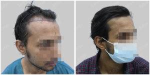 Men Hair Transplants: Satya hair Solutions
