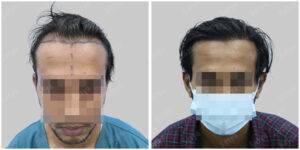 Men Hair Transplants: Satya hair Solutions