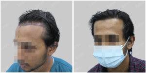 Men Hair Transplants: Satya hair Solutions