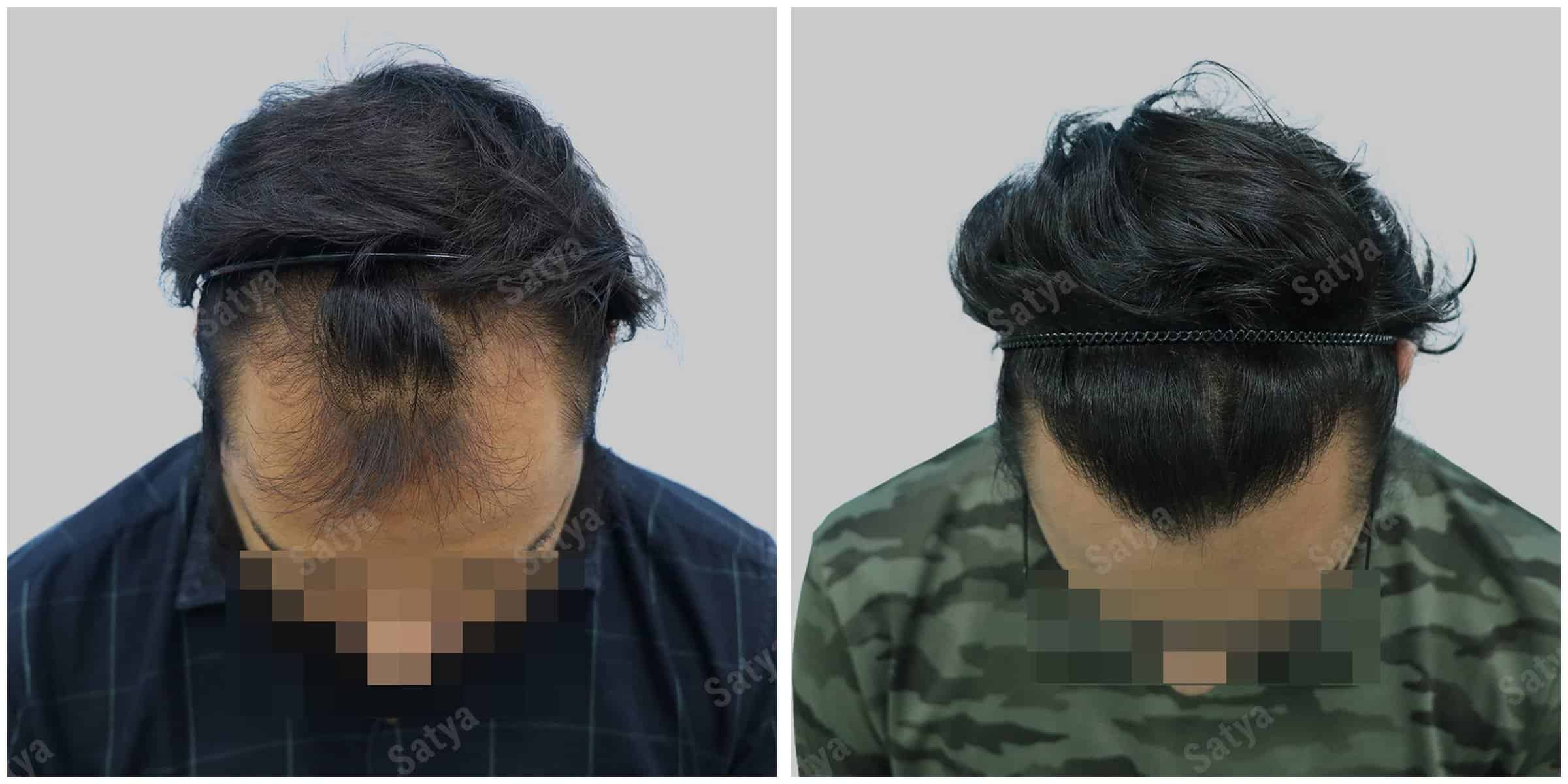 hair transplant results before and after