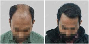 hair transplant results before and after