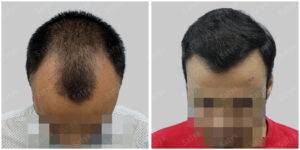 hair transplant results before and after