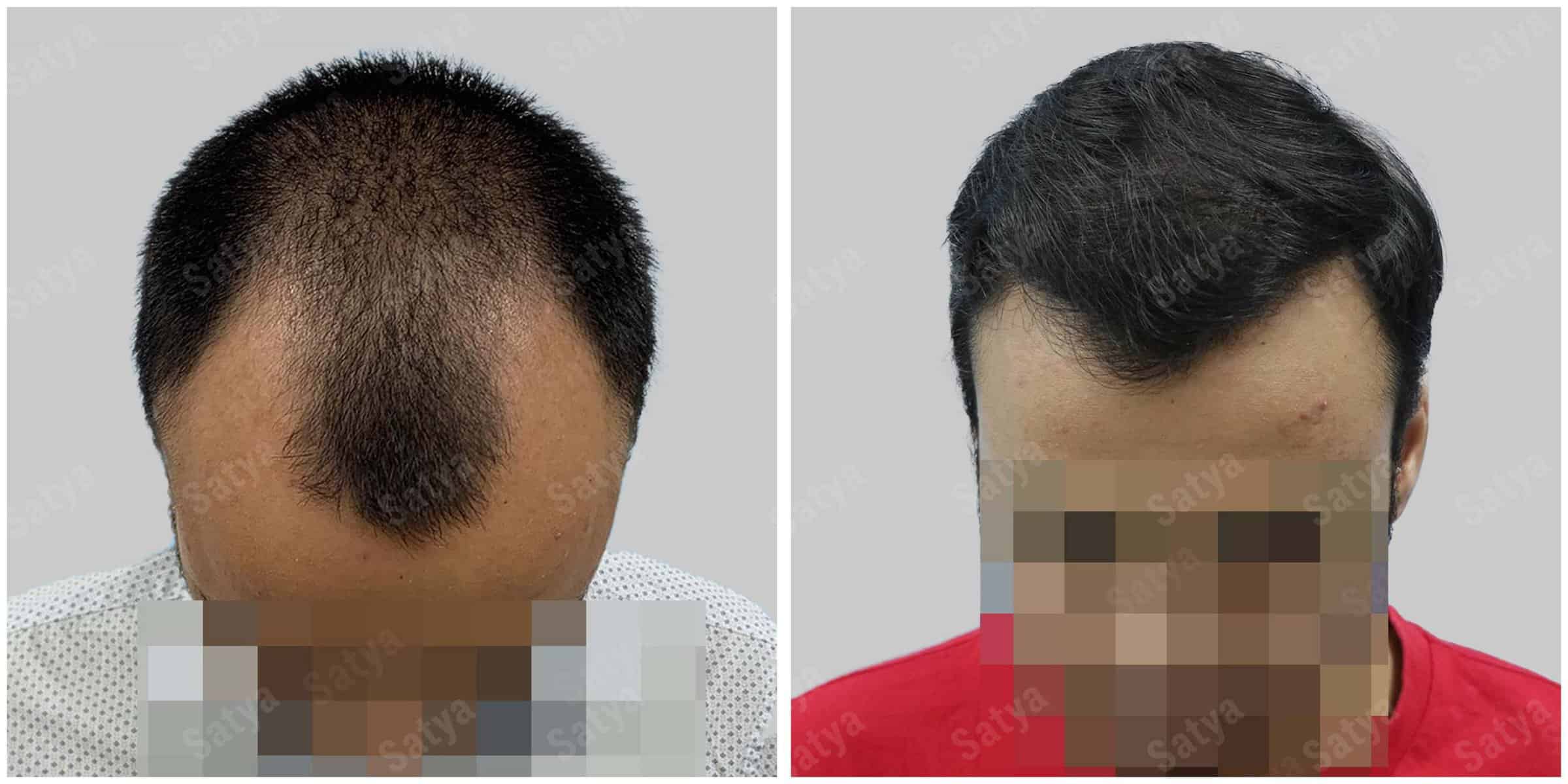hair transplant results before and after