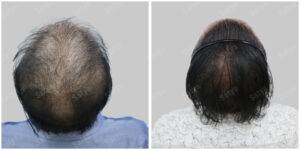 Men Hair Transplants: Satya hair Solutions