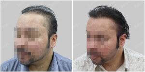 Men Hair Transplants: Satya hair Solutions