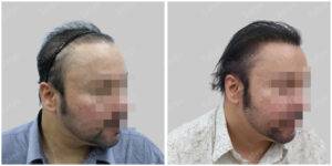 Men Hair Transplants: Satya hair Solutions