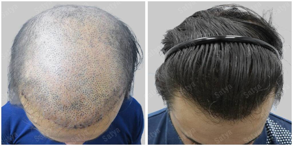 Hair Transplant for Men | before and after