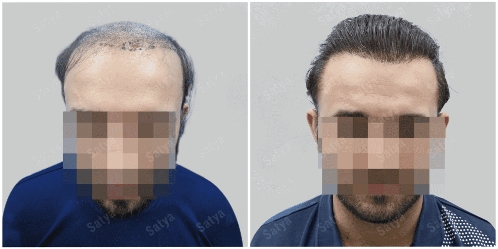 Hair Transplant for Men | before and after