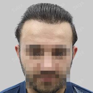 Hair Transplant for Men | before and after
