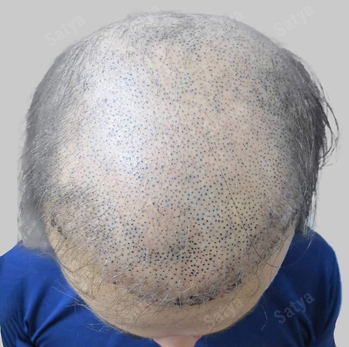 Hair Transplant for Men | before and after