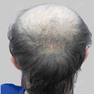 Hair Transplant for Men | before and after