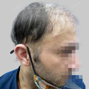 Hair Transplant for Men | before and after