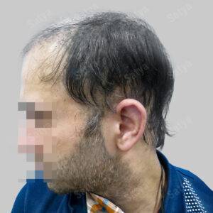 Hair Transplant for Men | before and after