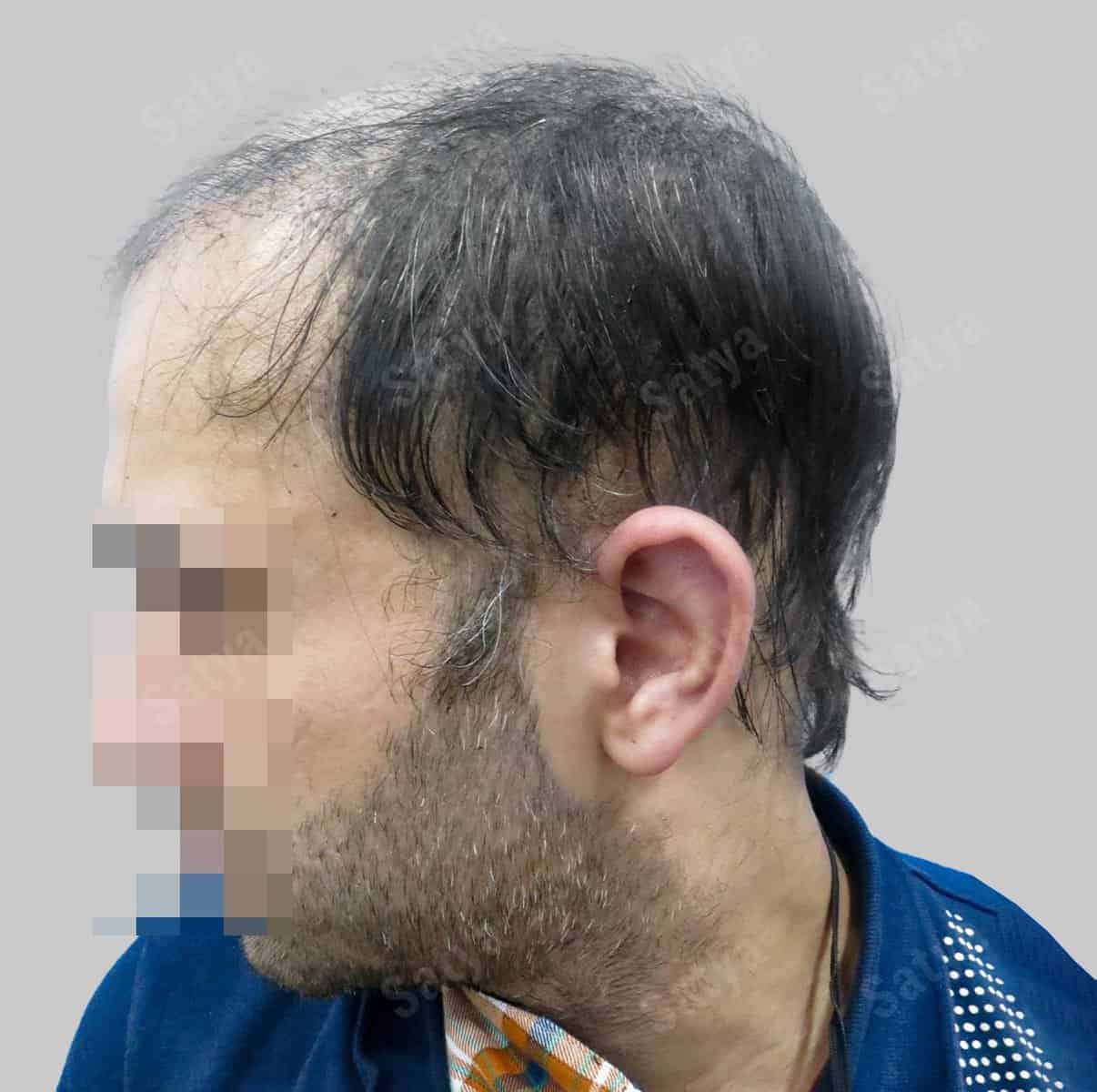 Hair Transplant for Men | before and after