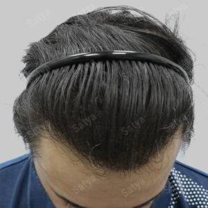 Hair Transplant for Men | before and after