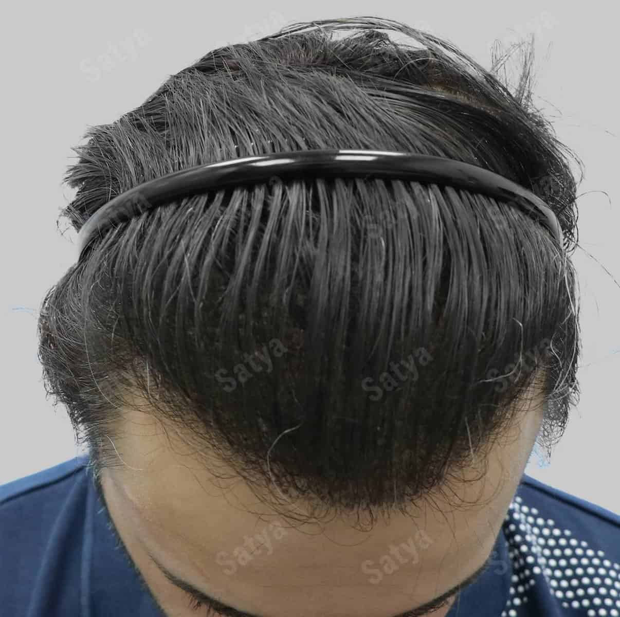 Hair Transplant for Men | before and after