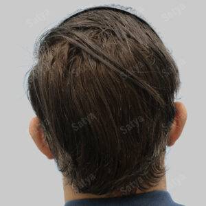 Hair Transplant for Men | before and after